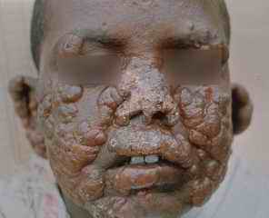 Diffuse Cutaneous Leishmaniasis (CL)
