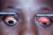 Trachoma