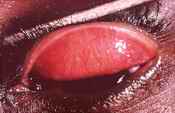 Trachoma
