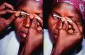 Trachoma