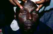 Trachoma
