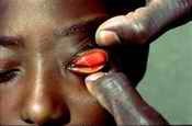 Trachoma