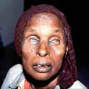 Trachoma