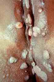 HIV/AIDS