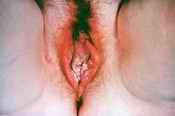 HIV/AIDS