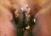 HIV/AIDS