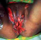 HIV/AIDS