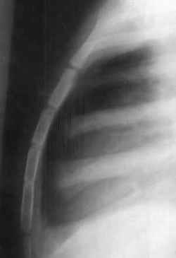 Fig 1. Lateral view of the chest showing sternum and its pieces in a 16 year old male [35 kb]