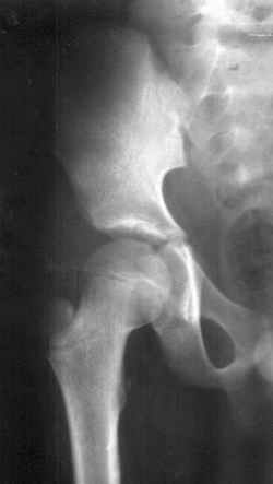 Figure 4. X-ray pelvis and femur in a fourteen and a half year old male [69 kb]