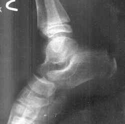 Figure 5. Lateral X-ray foot in a eight and a half year old male [66 kb]