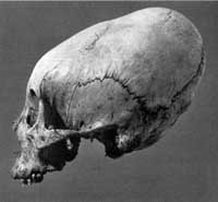 Artificial cranial deformation