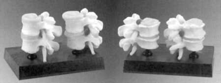 Four stage degenerative Lumbar set