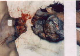 accidental guillotine