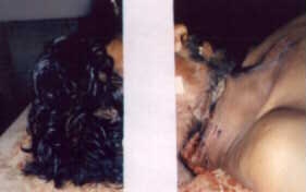 accidental guillotine