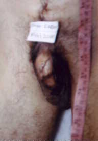 poster 3 - Abrasions on the Penis