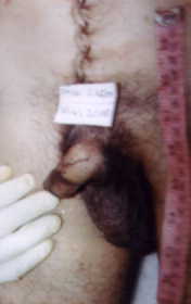 Abrasions Of The Penis: A Case Of Homicide