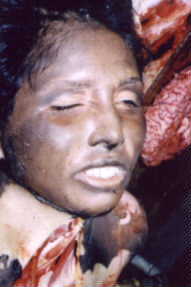 Case Of Burns: Dead Expresses Herself