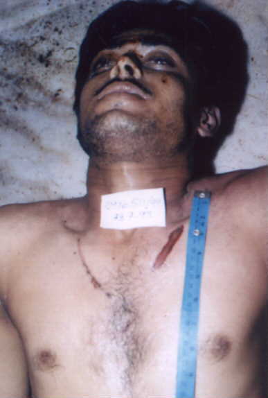 poster 1 - Electrocution: Contact Burns