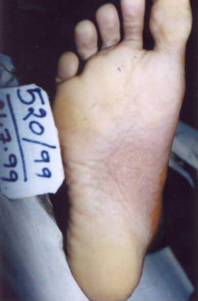 poster 3 - Post-mortem Lividity on Soles: A Case of Partial
 Hanging