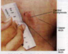 Bite mark on the breast