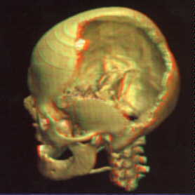 3D pictures of brain and skull