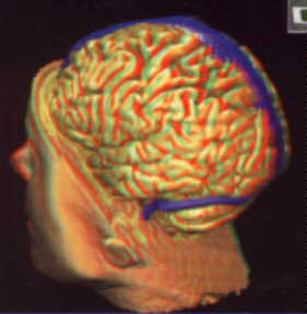 3D pictures of brain and skull