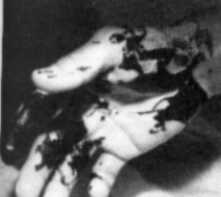 Hot tar burns to the hand