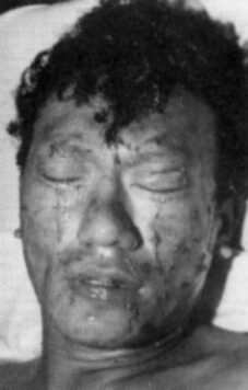 Hot tar burns to the face after removal with polyoxyethylene sorbitan