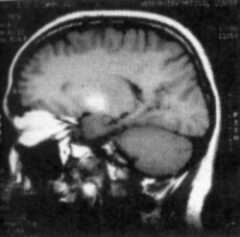 MRI scan showing deposition of manganese in area of basal ganglia - lateral view (Bright oval area)