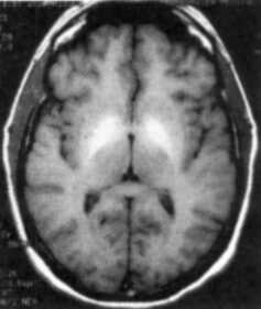 MRI scan showing deposition of manganese in area of basal ganglia - top view (Bright areas)