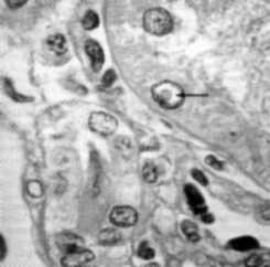 Lead inclusions in nucleus of tubular cells of kidney in the case of lead poisoning