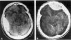CT images of Epidural hematoma