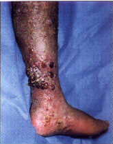 Classical Kaposi's sarcoma