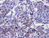 Endocrine Pathology- Differential Diagnosis And Molecular Advances