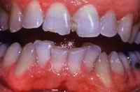 An intra-oral photograph of Ted Bundy