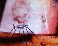 Courtroom exhibit showing the injury pattern is actually two bite marks nearly superimposed in the same area