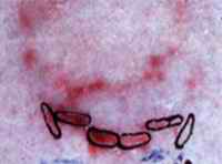 Close-up view of the bite marks