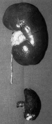 Burn defect of the skull cap resembling a gunshot wound