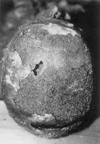 Burn defect of the skull cap resembling a gunshot wound