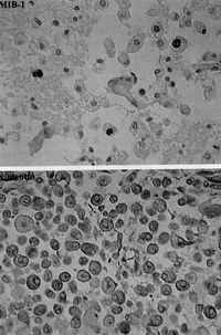 Burn defect of the skull cap resembling a gunshot wound