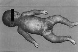 Waterhouse-Friderichsen syndrome