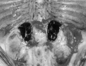 Waterhouse-Friderichsen syndrome