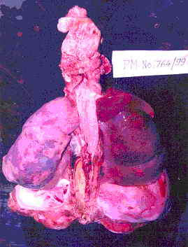 Figure 2: Corrosion of Esophagus