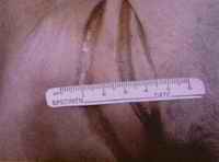 Ellen Sherman died of ligature and manual strangulation. Three parallel strangulation marks were found at autopsy