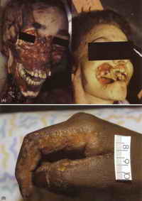 Postmortem injuries made by rodents - paired incisions without subcutaneous bleeding