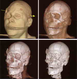 Encyclopedia of Forensic and Legal Medicine (4 volumes), edited by Jason Payne-James, Roger Byard, Tracey Corey and Carol Henderson