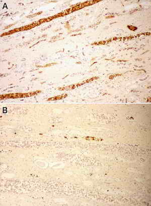 Figure 3. ABO group determination in the blood group incompatible case. 
The transfused A typed red blood cells indicated by arrows were easily detected inside blood vessels of the kidney with anti A antibody (photo A), and a large amount of O typed red cells shown by arrow inside blood vessels and collecting tubules were stained by anti H antibody (photo B)
