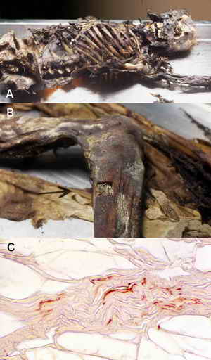 Figure 5. ABO grouping from mummified skin.
Endothelial cells of blood vessel in the mummified skin obtained from the leg (photo B) of a skeleton body (photo A) showed reactivity with corresponding anti body as shown in photo C. The PCR product of DNA obtained from the mummified skin could not be amplified