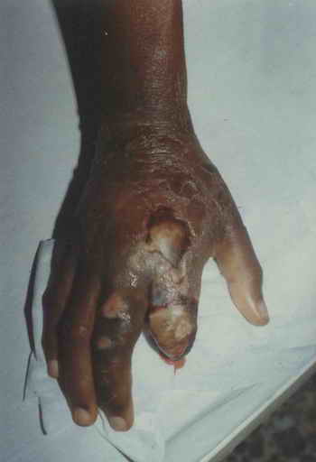 Figure 1: Auto-amputation of the terminal phalanx of the index finger