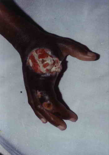 Figure 2: Post surgical disarticulation of the index finger, and hand ulcer following a broomstick injury